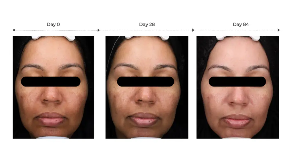 before and after photo for brown patches