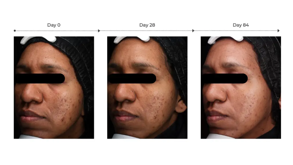 before and after photo for dark spots